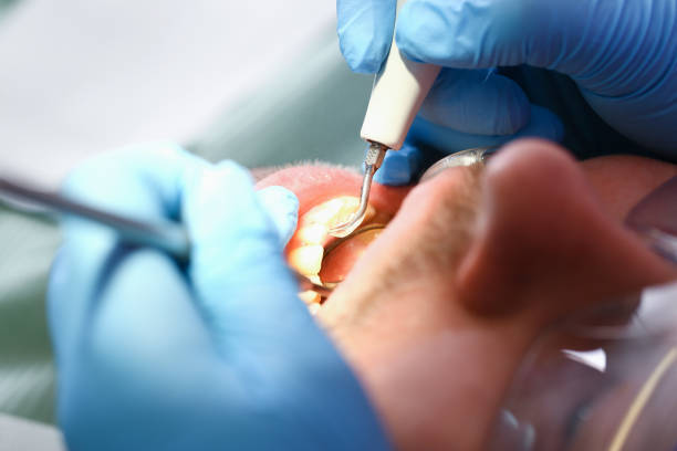 Best Knocked-Out Tooth Emergency  in Fort Recovery, OH
