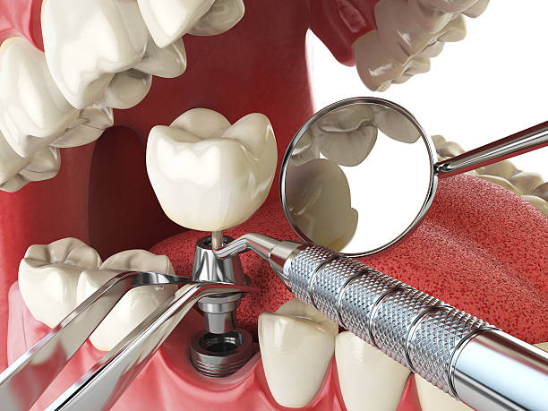 Best Teeth Whitening  in Fort Recovery, OH